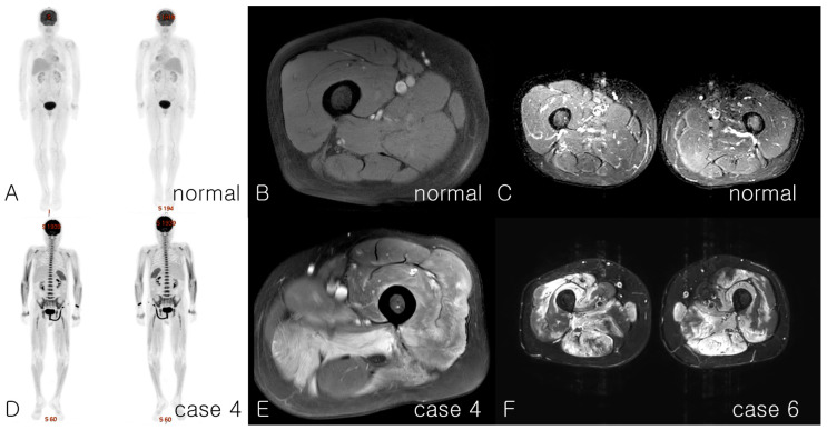 Clinical Characteristics and Management of Statin-Associated Anti-3-Hydroxy-3-Methylglutaryl-Coenzyme A Reductase Immune-Mediated Necrotizing Myopathy.
