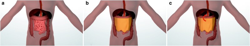 Hiatal hernia after open versus minimally invasive transthoracic oesophagectomy for cancer.