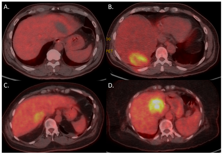 Predicting Tumor Recurrence with Early 18F-FDG PET-CT After Thermal and Non-Thermal Ablation.