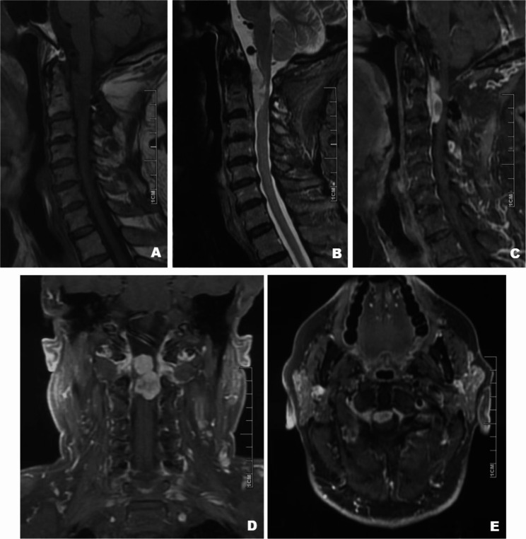 TERT promoter C250T mutation in a recurrent cervical chordoid meningioma: a unique case report.