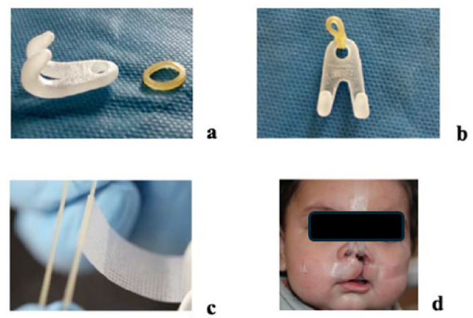 Expanding Access to Presurgical Cleft Care: Digital Nasoalveolar Molding with Clear Aligners in a Rural Low-Income Population.