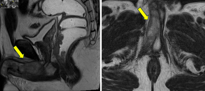 A Forty-Three-Year-Old Male With Penile and Cavernous Metastases From Rectal Cancer.