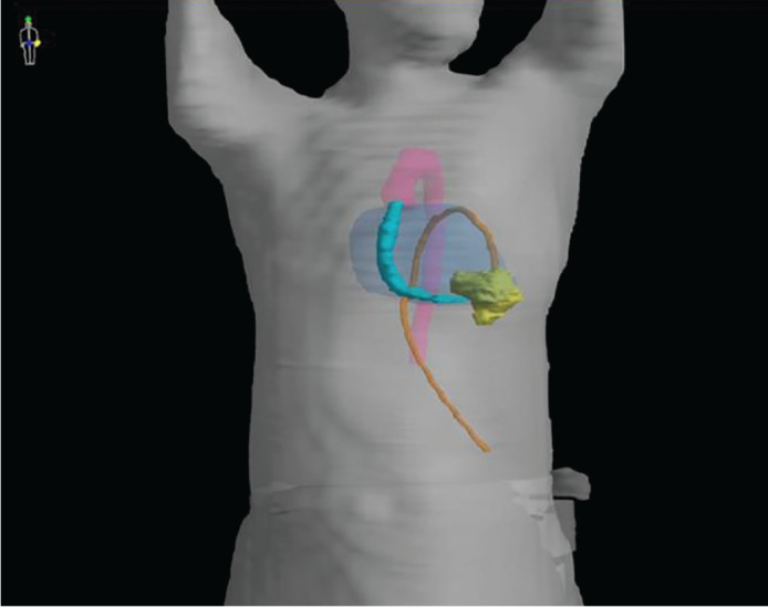 Safe Delivery of Radiotherapy for Breast Cancer Patient With Left Ventricular Assist Device: Case Report and Review of the Literature.