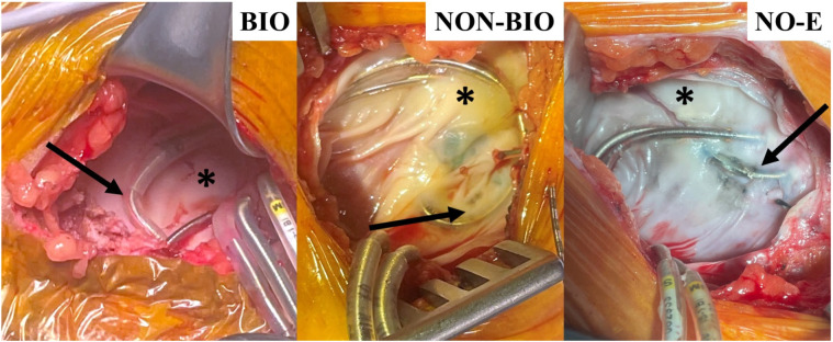 Preclinical and clinical evaluation of ECM bioenvelopes for preventing CIED pocket complications.