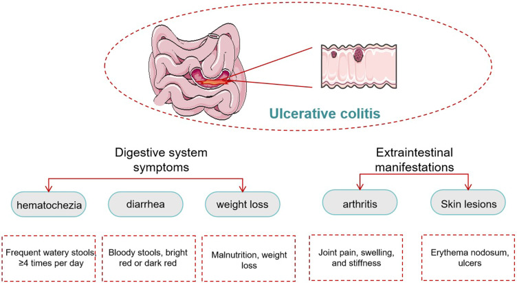Mechanism of Morbidity Based on Ulcerative Colitis: A Review of Traditional Chinese Medicine Treatment of Ulcerative Colitis.
