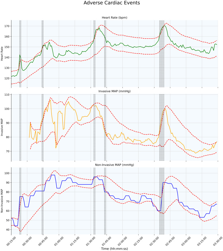 Identification of physiological adverse events using continuous vital signs monitoring during paediatric critical care transport: A novel data-driven approach.