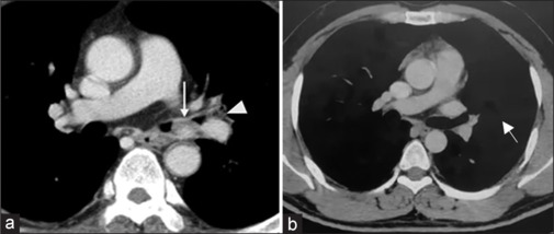 Bronchoscopic management of endobronchial hamartomas using "hot and cold" therapies - Initial experience in two patients.