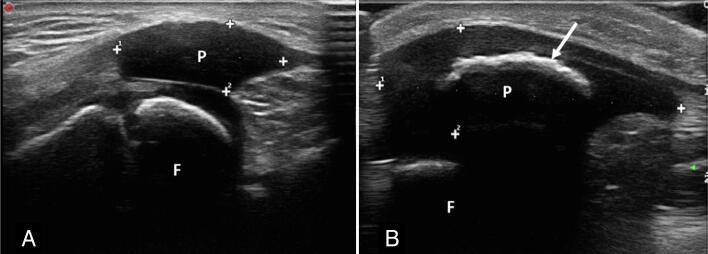 ULTRASONOGRAPHY OF THE CARTILAGINOUS PATELLA IN PEDIATRIC PATIENTS: A CASE SERIES.