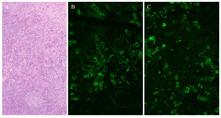 The Incidence of IgG4-Related Disease in Slovenia-Single-Centre Experience.