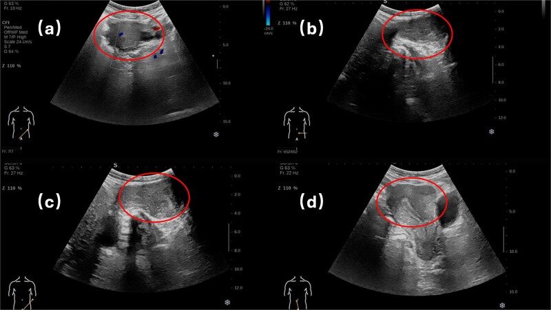 Adenomyoma of the round ligament of the uterus in the inguinal canal: a case report.