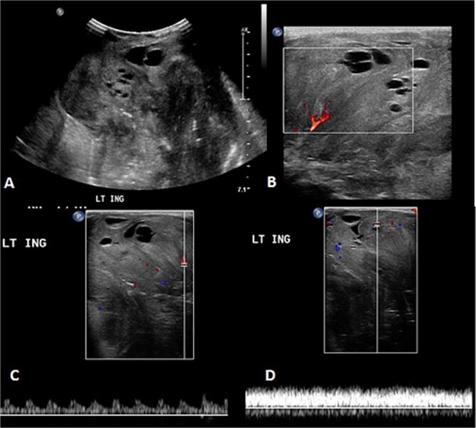 Is it a hemangioma? A combined case report of soft tissue sarcomas mimicking infantile hemangioma.