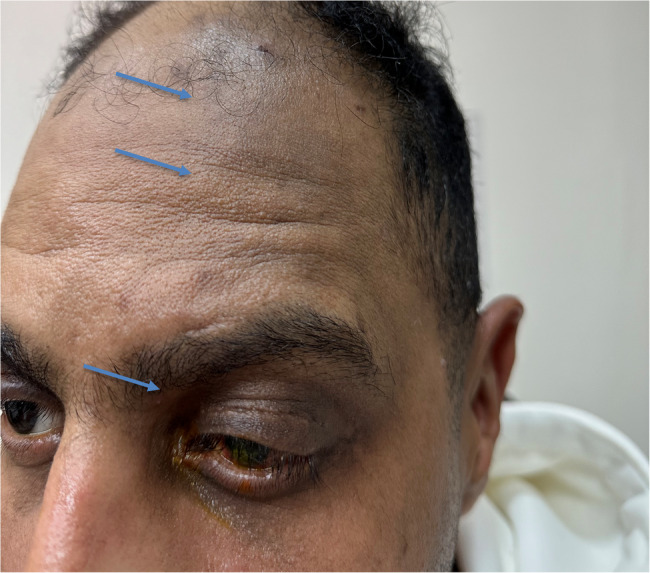 Post-corneal tattooing trigeminal nerve-distributed hyperpigmentation: a case report.