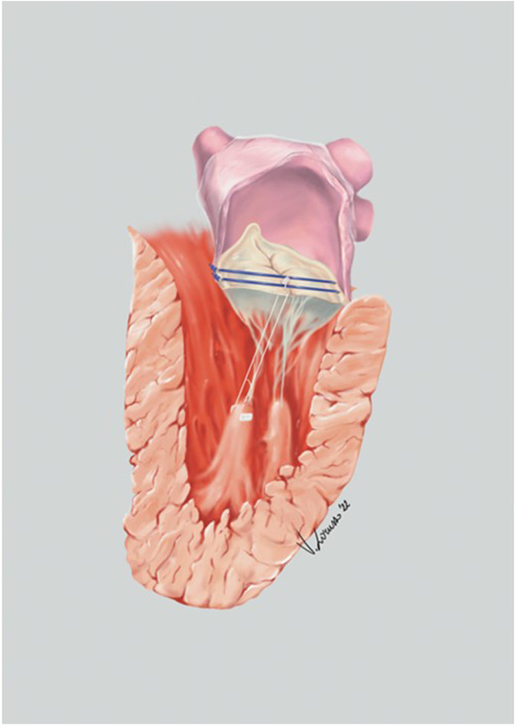 Five-year comparative outcomes of the track technique versus conventional artificial chordae sizing in anterior mitral leaflet repair.