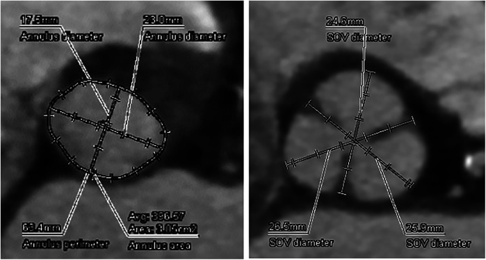 Assessment and treatment of left ventricular pseudoaneurysm due to wire injury in transcatheter aortic valve implantation: a case report.