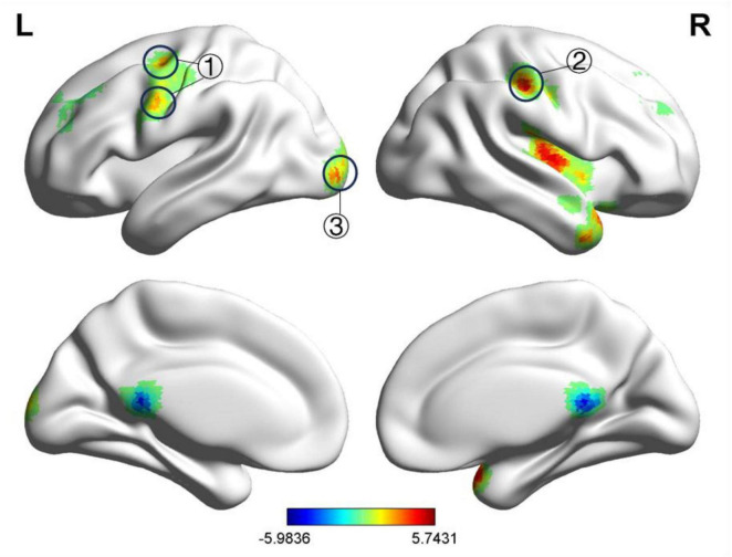 Exploring the potential central regulatory mechanisms of acupuncture for acute-stage Bell's palsy: an fMRI-based investigation.