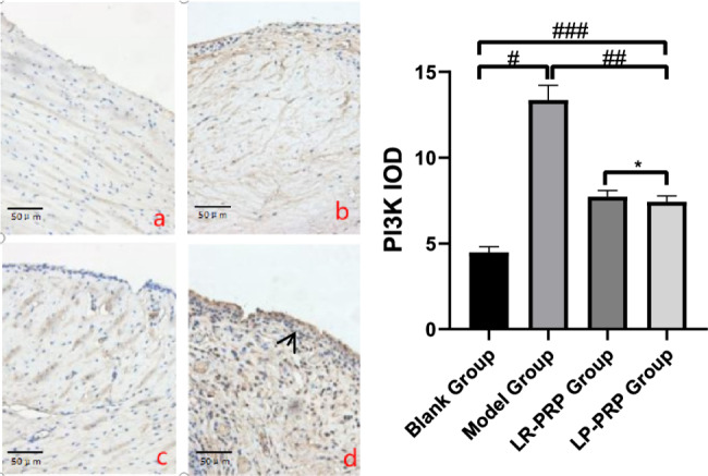 Comparison of the therapeutic efficacy of leukocyte-poor and leukocyte-rich platelet-rich plasma in rabbit knee osteoarthritis and the study of autophagy mechanism.