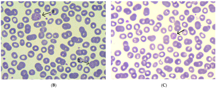 Recurrent Malaria with <i>Plasmodium vivax</i>: A Case Report and Brief Review of the Literature.