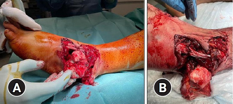 Open total talar dislocation treated with reimplantation of the talus and reverse adipofascial sural flap: a case report.