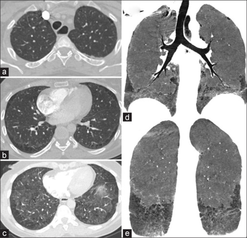 Atypical lung emphysematous changes in systemic sclerosis.