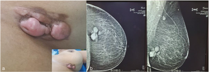Dermatofibrosarcoma Protuberans of the Breast.