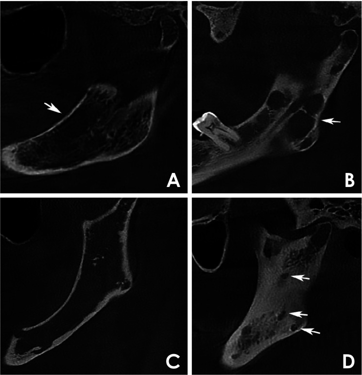 Cone-beam computed tomography-based analysis of jawbone destruction patterns in multiple myeloma: Associations with clinical data in an observational study.