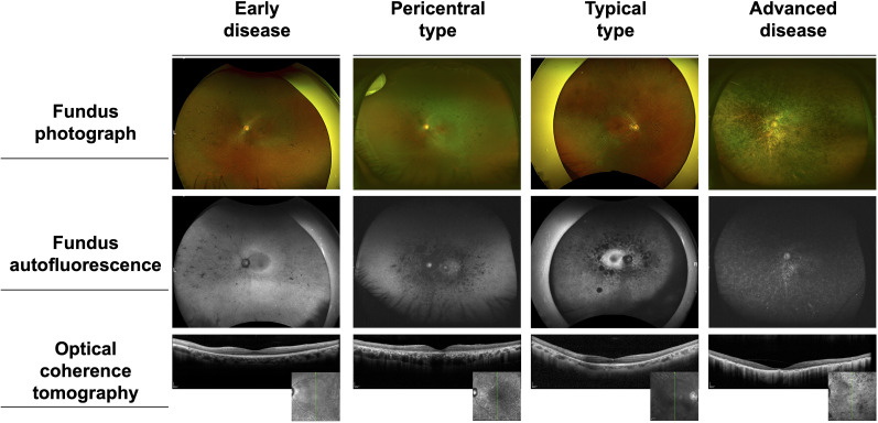 Deep phenotyping of eyes shut homolog-associated retinopathy based on visual impairment patterns.