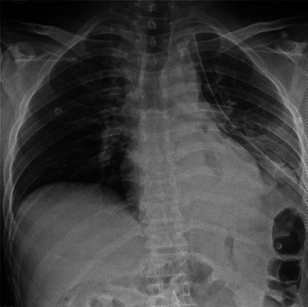 Minimally Invasive Treatment of Traumatic Diaphragm Rupture.
