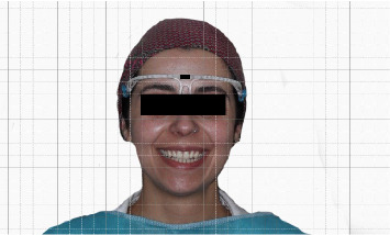 Evaluating Canine Positioning Relative to Facial Landmarks: A Study on the Accuracy of the Inner Canthus and Alar of the Nose as Reference Points.