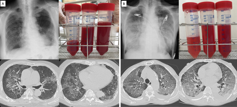 Diffuse Alveolar Hemorrhage Associated with Herbal Medicine: A Case Series and Literature Review.