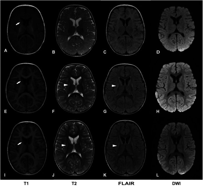 Case Report: Biallelic variants in <i>MRPS36</i>, encoding a component of the 2-oxoglutarate dehydrogenase complex, cause leigh syndrome.