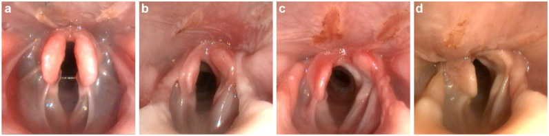 Effect of unilateral arytenoid lateralisation on the rima glottidis volume in cats: a cadaveric study.