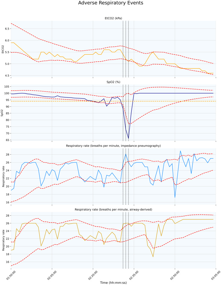 Identification of physiological adverse events using continuous vital signs monitoring during paediatric critical care transport: A novel data-driven approach.