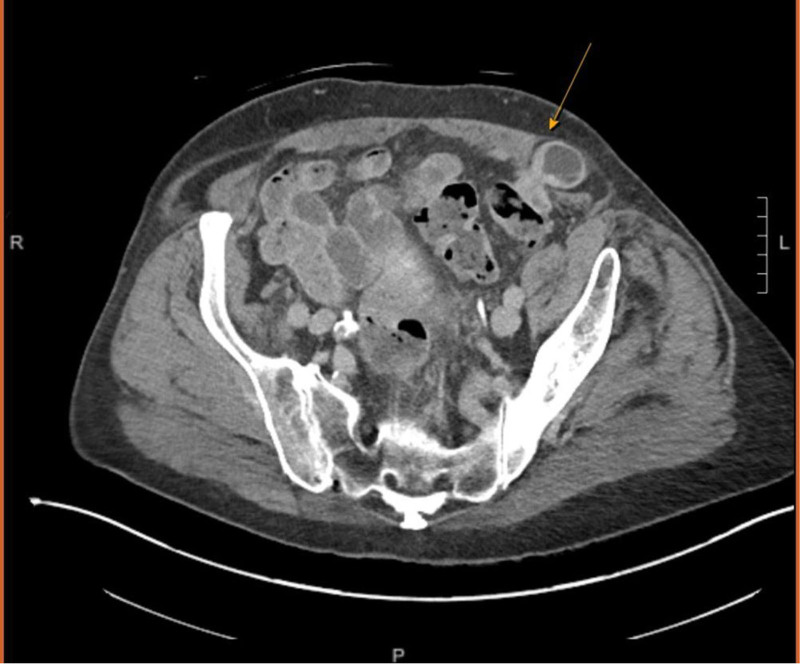 Missed Abdominal Wall Hernias.