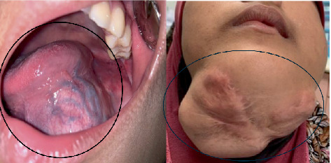 Odontogenic Fibromyxoma in a Pediatric Patient: A Rare Aggressive Neoplasm With Recurrent and Fatal Outcome.