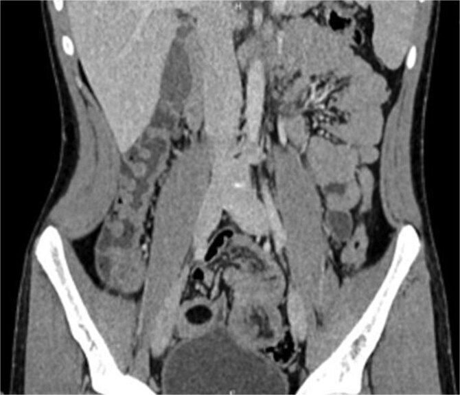 Jejunal lipoma presenting as small bowel intussusception in an adult: diagnostic and surgical challenges-a case report.