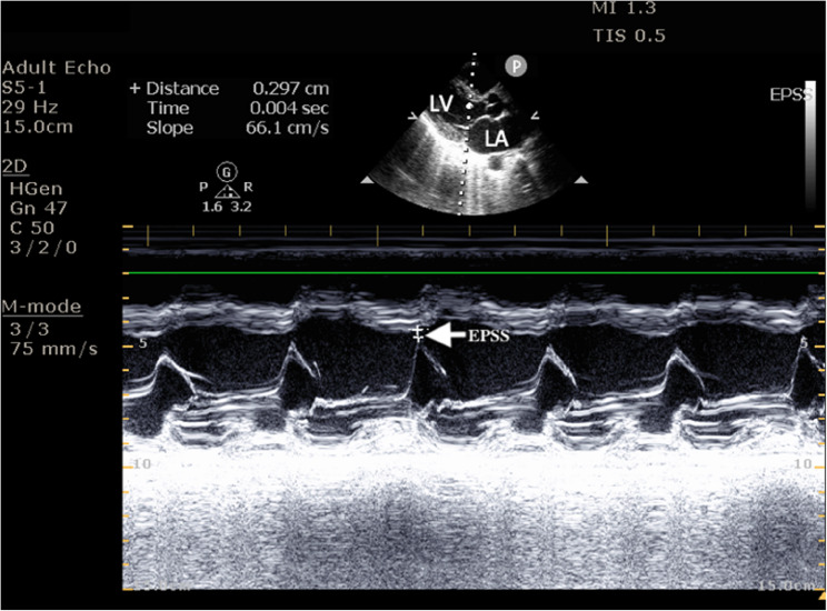 Right ventricular dysfunction: a key predictor of post-intubation hypotension in the emergency department.