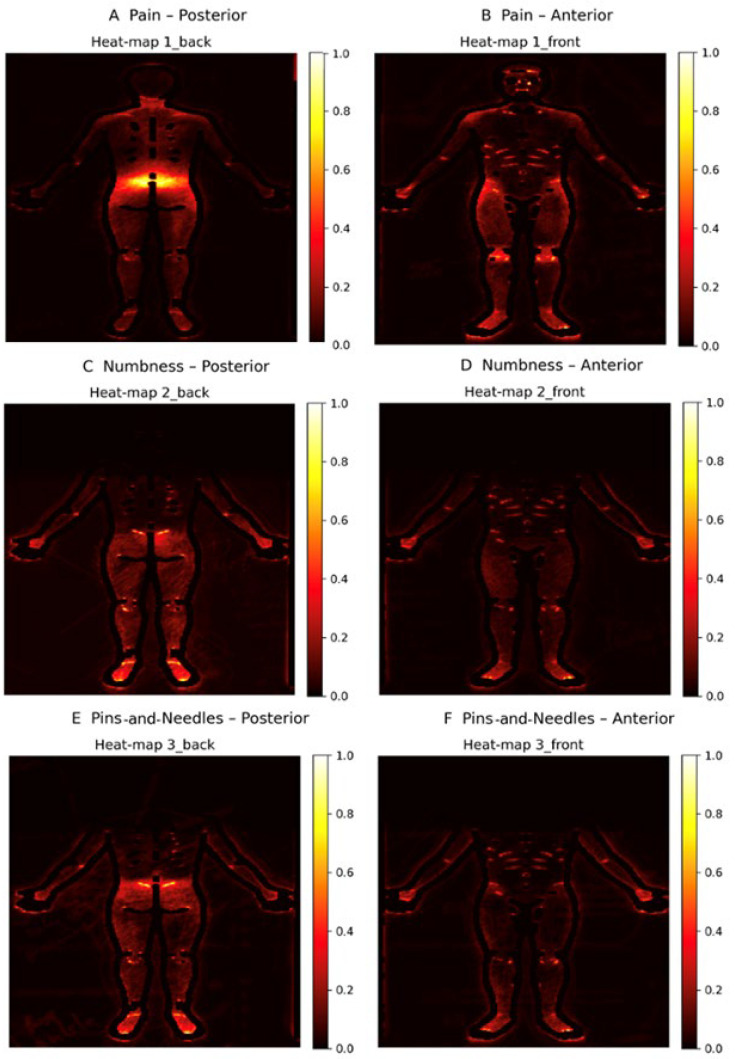 A Summary of Pain Locations and Neuropathic Patterns Extracted Automatically from Patient Self-Reported Sensation Drawings.