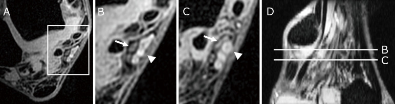 Preoperative Magnetic Resonance Imaging Findings in Patients with Tarsal Tunnel Syndrome and Postoperative Outcomes.