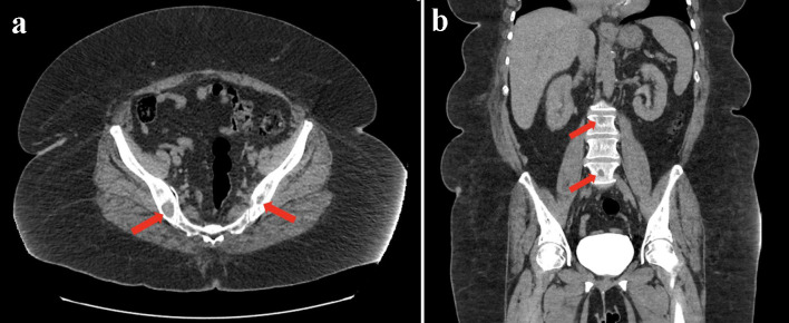 Acute Hepatitis in a Patient Treated With Ribociclib for Metastatic Breast Carcinoma.