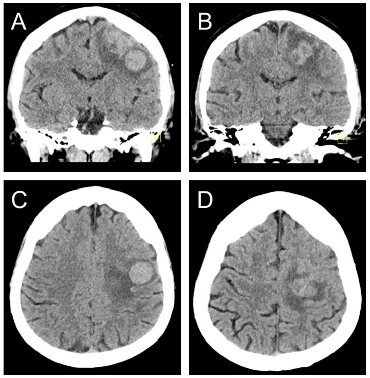 Intracranial Metastases from Uterine Leiomyosarcoma: A Systematic Review and Case Illustration.