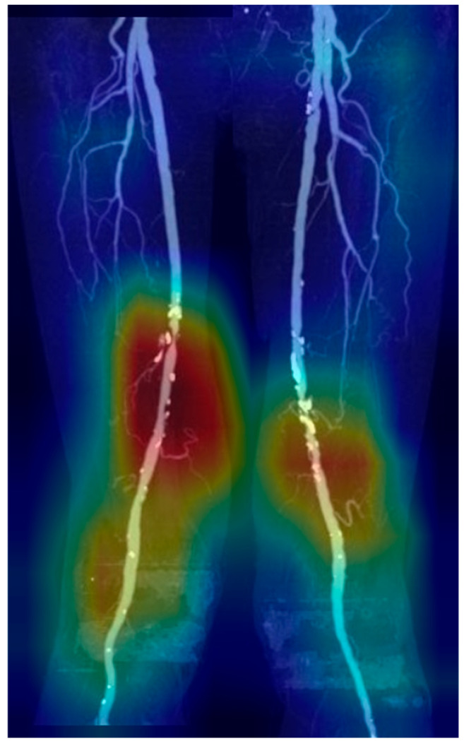 Deep Learning-Based Diagnosis of Femoropopliteal Artery Steno-Occlusion Using Maximum Intensity Projection Images of CT Angiography.