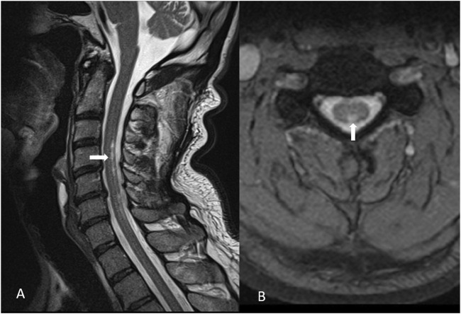 Mercury exposure leading to functional vitamin B12 deficiency and subacute combined degeneration: a case report and literature review.
