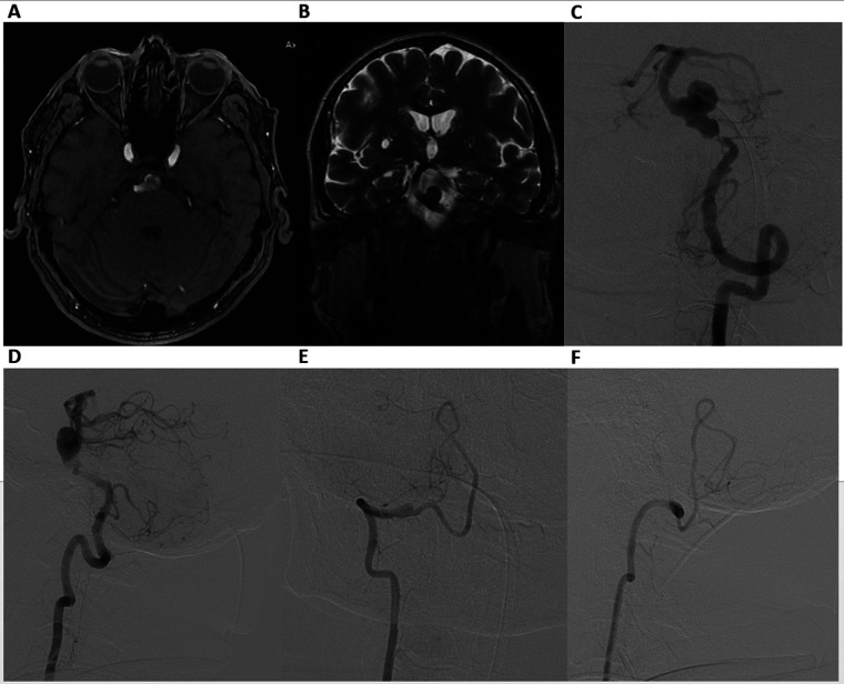 Case Report: "Stent-within-a-Stent" technique after telescopic flow diverter reconstruction for basilar artery aneurysm with proximal stenosis.