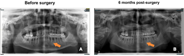 Incidence and risk factors of postoperative complications following periodontal flap surgery: a retrospective study.
