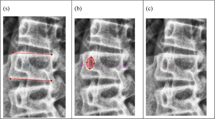 How the curve morphology differs between curve types in patients with adolescent idiopathic scoliosis during brace treatment?