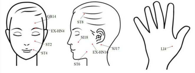 Exploring the potential central regulatory mechanisms of acupuncture for acute-stage Bell's palsy: an fMRI-based investigation.