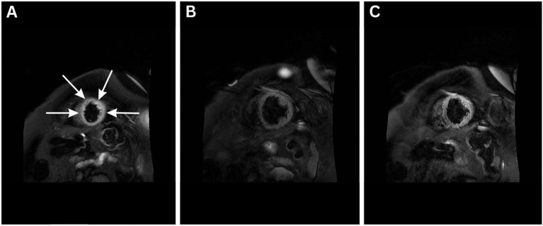 Case Report: Adjunctive hemoadsorption therapy in a patient with Takotsubo cardiomyopathy and hyperinflammation.
