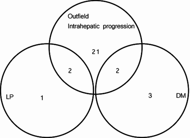 Magnetic resonance imaging-guided radiotherapy for portal vein tumor thrombus in hepatocellular carcinoma: outcomes and prognostic factors.