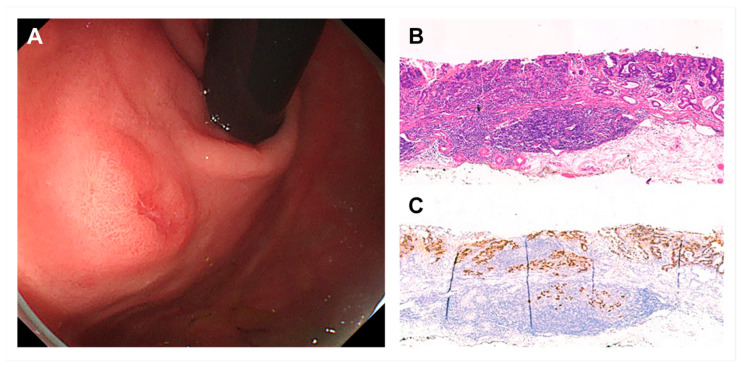 Clinicopathological Features and Outcomes of Endoscopic Submucosal Dissection for Early Gastric Lymphoepithelioma-like Carcinoma.
