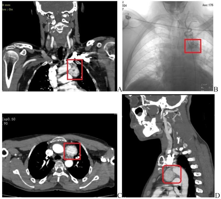 Multiple paragangliomas diagnosed in head, neck, and mediastinum: a case report.
